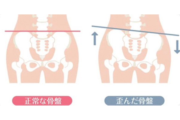 骨盤の歪み