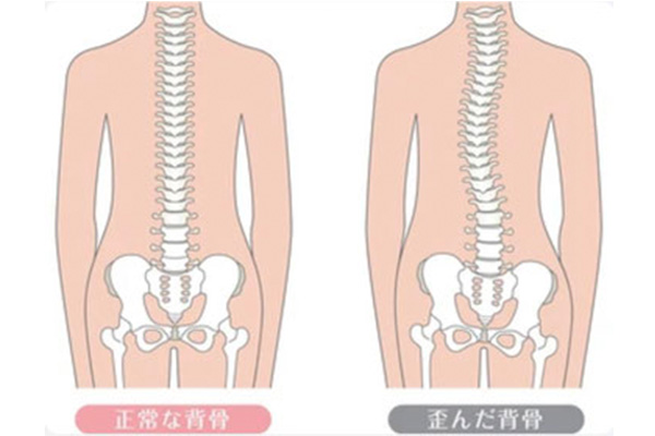 背骨の歪み